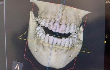 Implantologia guidata 3D