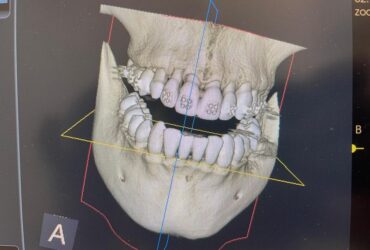 Implantologia guidata 3D