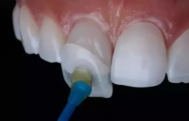 Faccette dentali estetiche
