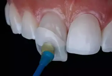 Faccette dentali estetiche