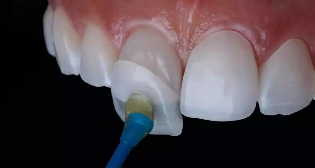 faccette-dentali-soluri